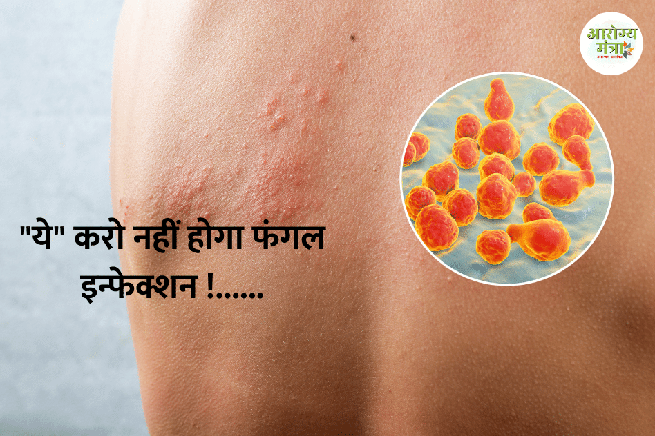 What are the causes of fungal infection : “ये” करो नहीं होगा फंगल इन्फेक्शन !……