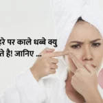 Why do we get dark spots on our face : हमारे चेहरे पर काले धब्बे क्यु पडते है! जानिए …