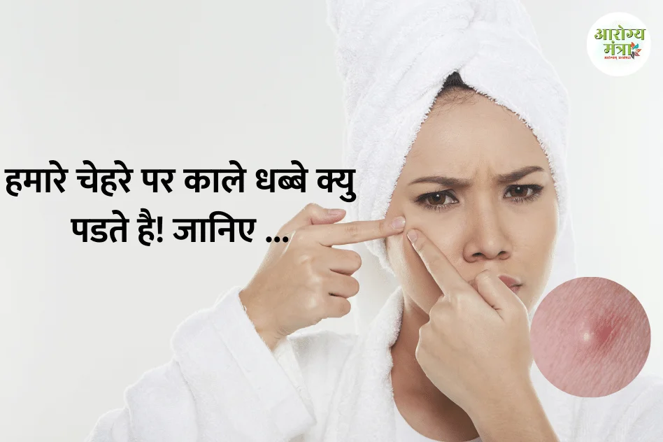 Why do we get dark spots on our face : हमारे चेहरे पर काले धब्बे क्यु पडते है! जानिए …