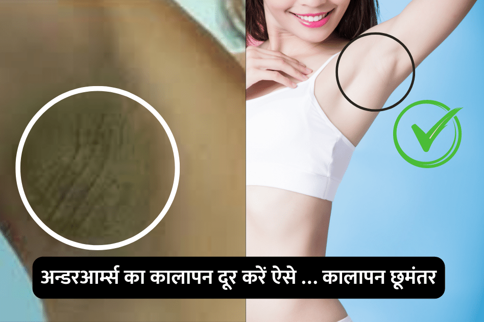 Get rid of dark underarms